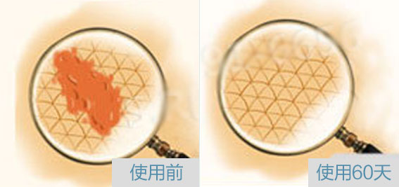 祛疤4