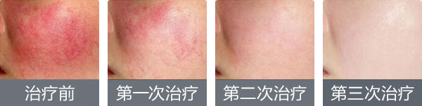 红血丝修复9