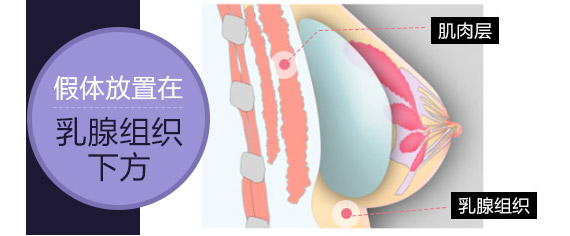 传统的单平面隆胸方法