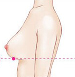 正常的乳房形态