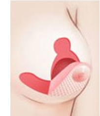 O型切开法矫正乳房下垂