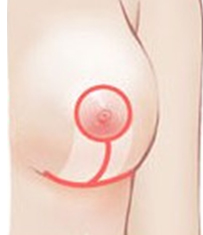 O型切开法矫正乳房下垂