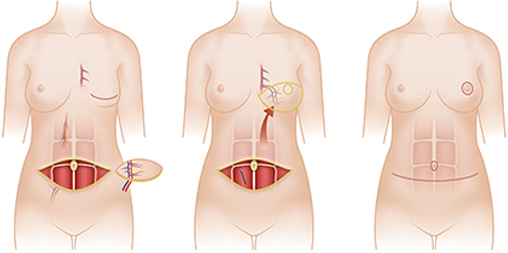 腹部组织乳房再造