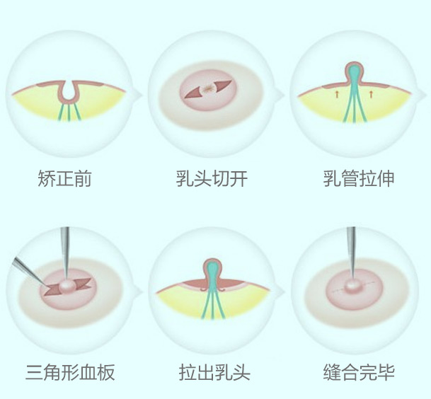 轻度乳头内陷矫正方法