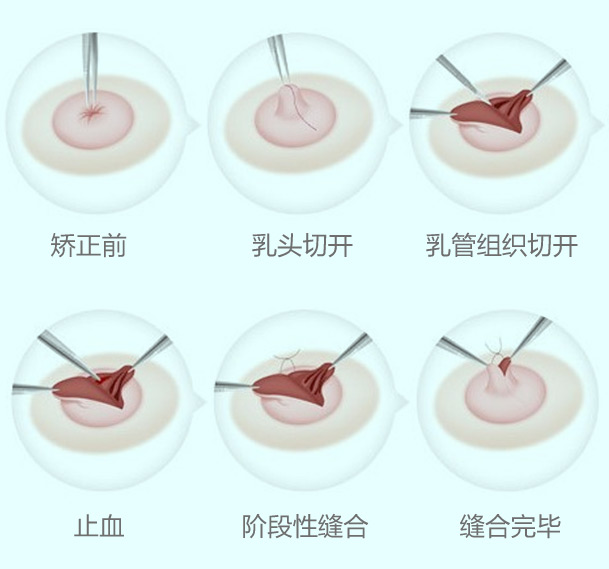 重度乳头内陷矫正方法