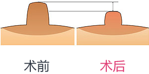 乳头缩小手术