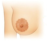 乳晕缩小手术