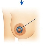 乳晕缩小步骤