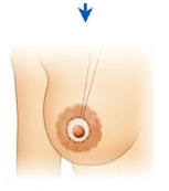 乳晕缩小手术过程