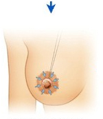 乳晕缩小术